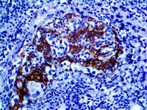 IHC of Cytokeratin 5 & 14 on an FFPE Breast Tissue Tissue